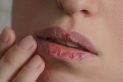 Dry Mouth