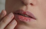 Dry Mouth